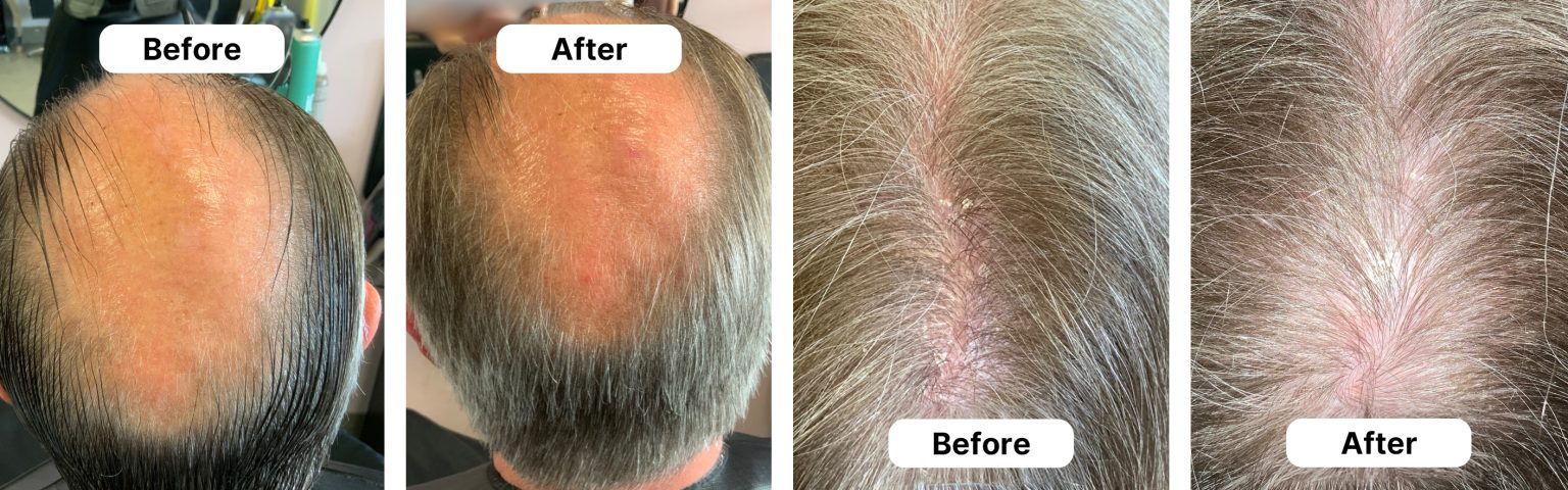 HUSSSH® hair recovery — before and after results