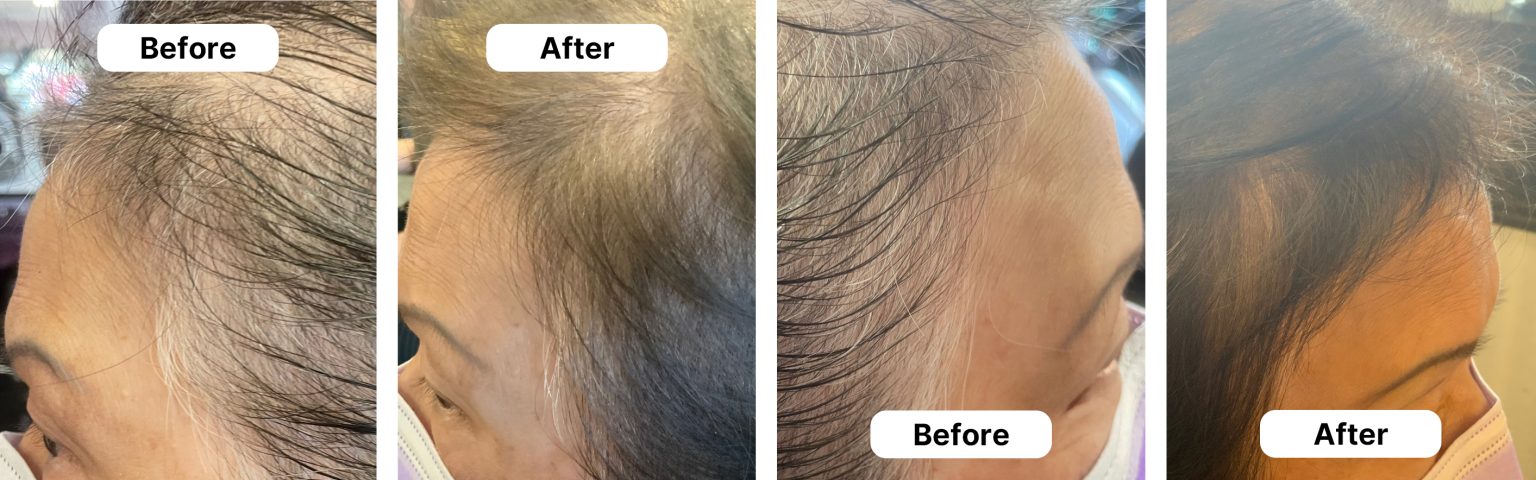 HUSSSH® hair recovery — before and after results